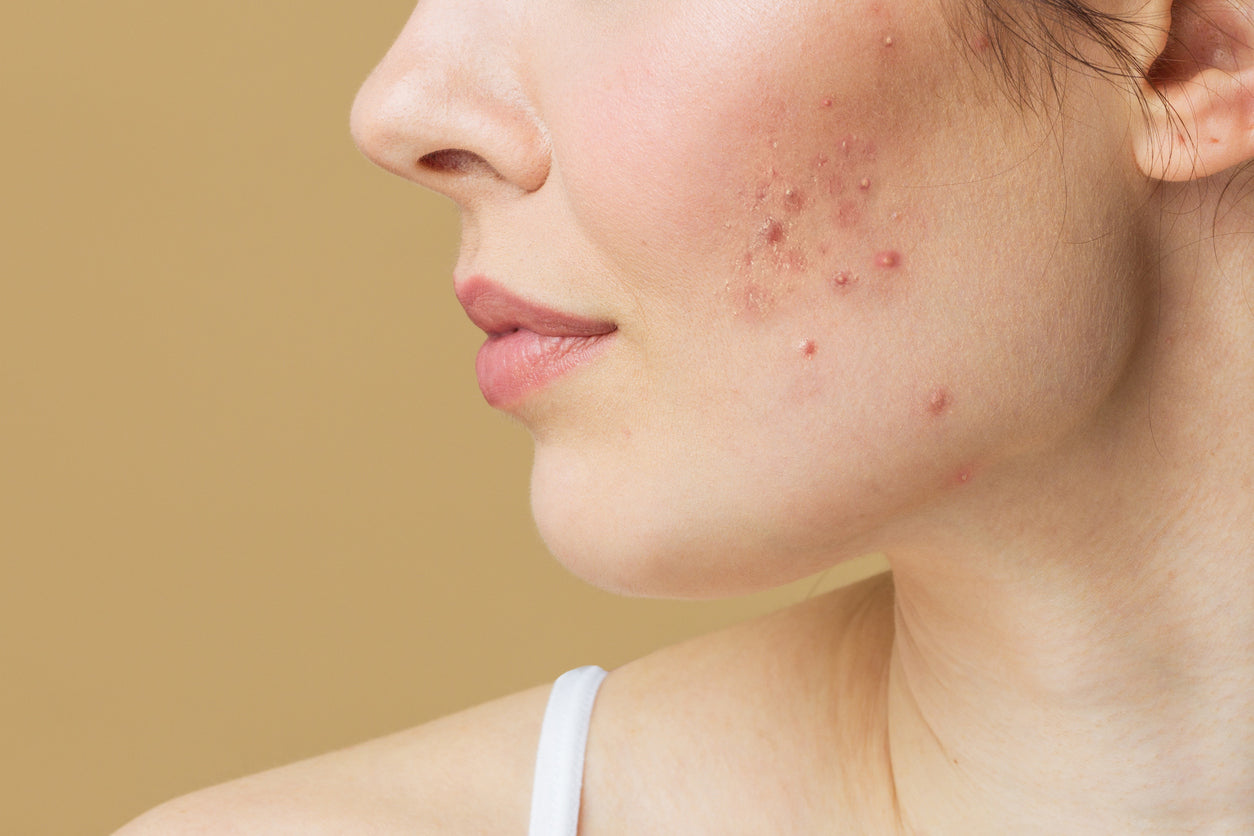 Acne Facial & Peeling