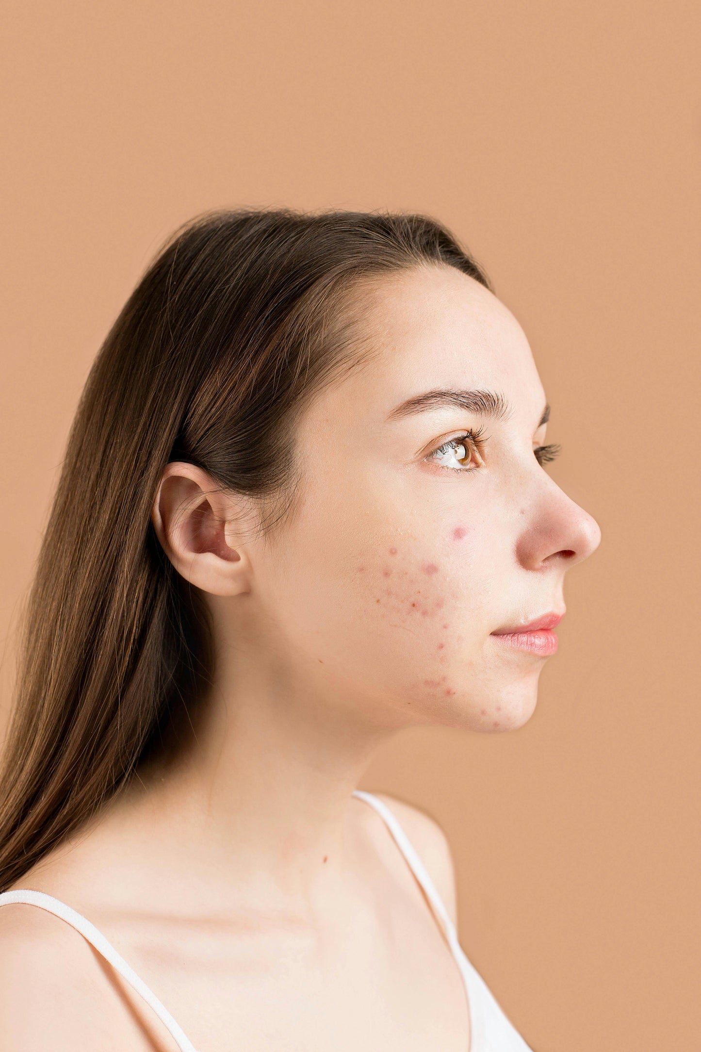 Tratamiento facial antiacné para adolescentes