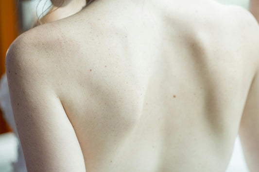 Diode Laser Full Back and Shoulders – 10 Sessions